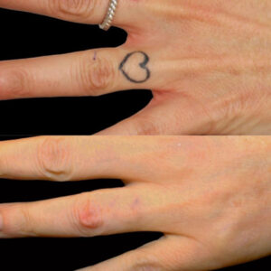 A professional setting at Rio Beauty Clinic where a specialist performs a laser treatment, providing a safe solution for how to get tattoo off permanently.