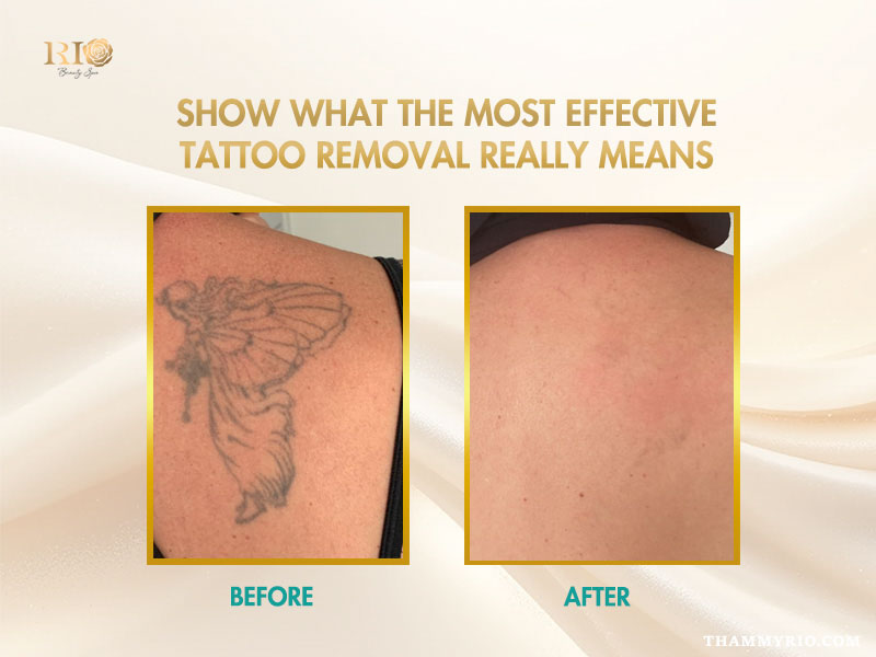 Effective laser treatment for how to get tattoo off safely