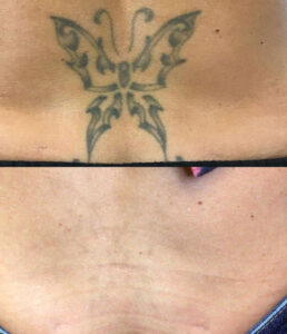 How to get tattoo off safely without damaging skin - Thẩm Mỹ Rio Beauty Clinic