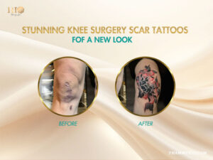 Before and after transformation of knee surgery scar tattoos in Hanoi.