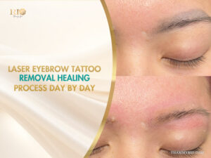 Close-up showing laser eyebrow tattoo removal healing process with visible redness and fading ink.