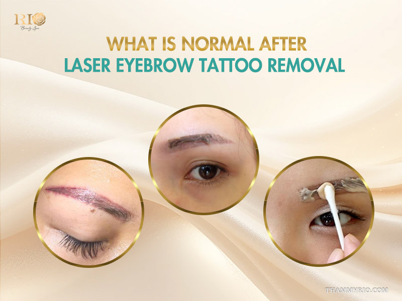 A woman showing the different stages of the laser eyebrow tattoo removal healing process including skin crusting and post-treatment care.