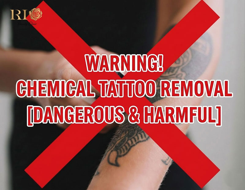 Severe skin damage caused by tattoo removal using chemical solutions compared to safe laser at Rio Beauty Clinic.