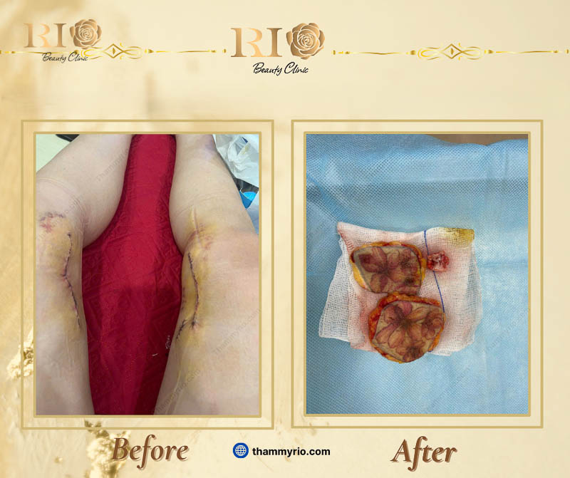 Risks of surgical tattoo removal causing permanent scars vs safe laser at Thẩm mỹ Rio Beauty Clinic.
