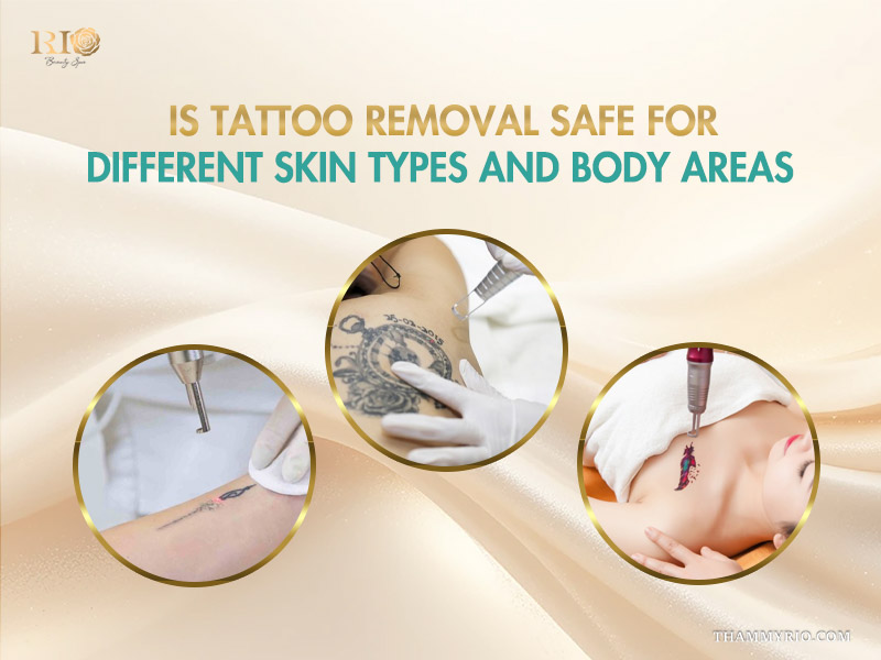 Professional laser tattoo removal is it safe for different skin types and body areas.