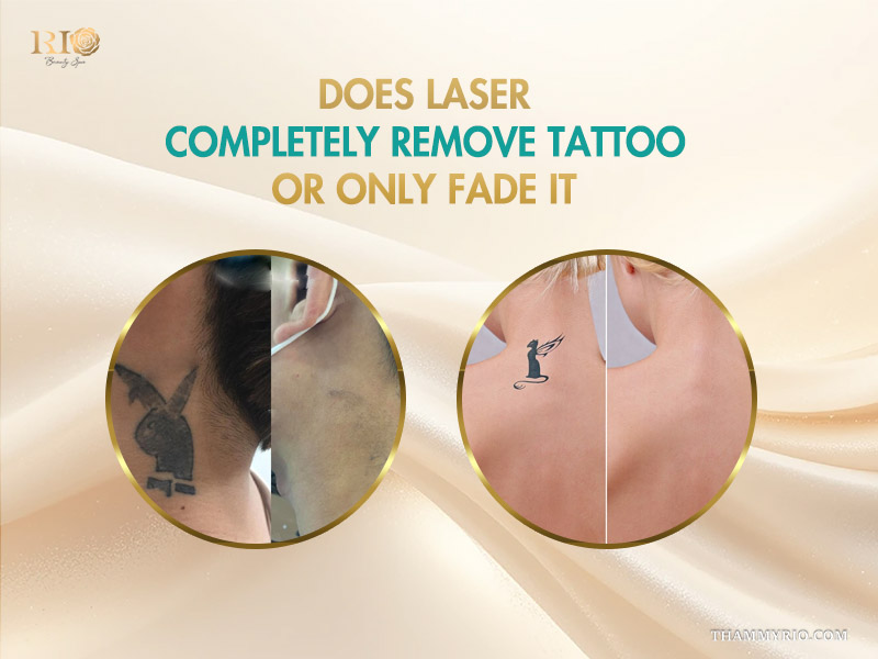Comparison showing laser tattoo removal is it safe and effective results on neck and back.