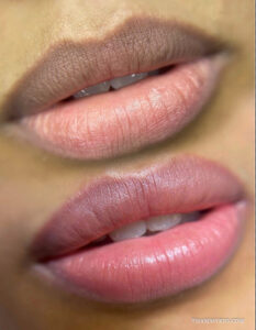 Lip neutralization before and after transformation showing the correction of dark lip borders to a healthy pink glow..