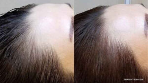 Before and after results of microblading hairline near me in Hanoi at Rio Beauty Clinic showing natural hair density improvement.