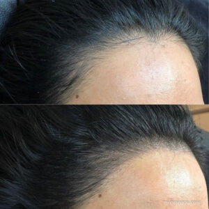 Close-up comparison of natural hair strokes from microblading hairline near me in Hanoi at Rio Beauty Clinic.