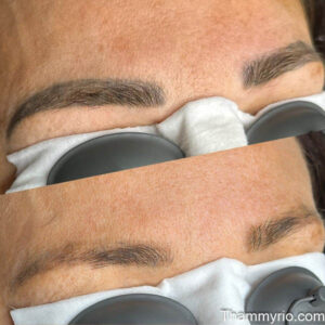 Before and after results of microblading laser removal showing significant pigment fading on eyebrows.