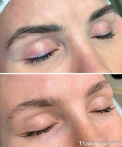 Before and after comparison of a microblading laser removal session showing significantly faded pigment and skin recovery.