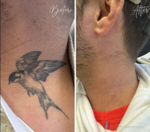 Side view of a man's neck before and after a swallow bird neck tattoo removal treatment.