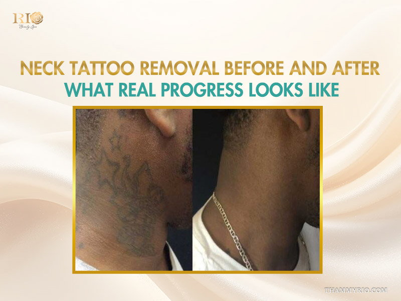 Real progress of neck tattoo removal on dark skin featuring star and script patterns.
