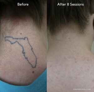 Back of neck tattoo removal before and after 8 sessions showing a Florida map outline fading completely.