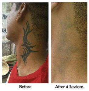 Side view of tribal neck tattoo removal before and after 4 laser sessions on a man's neck.