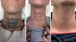 Three-stage progress of a crown and script neck tattoo removal on a man's throat area.
