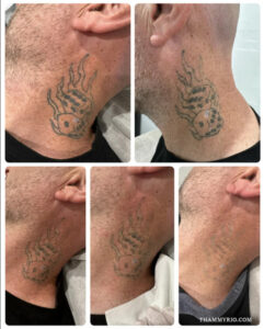Multiple stages of flaming dice neck tattoo removal showing gradual fading through laser therapy.