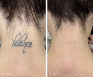 Before and after comparison of a successful neck tattoo removal showing the word balance completely faded.