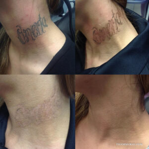 Progressive stages of neck tattoo removal for a black ink word tattoo.
