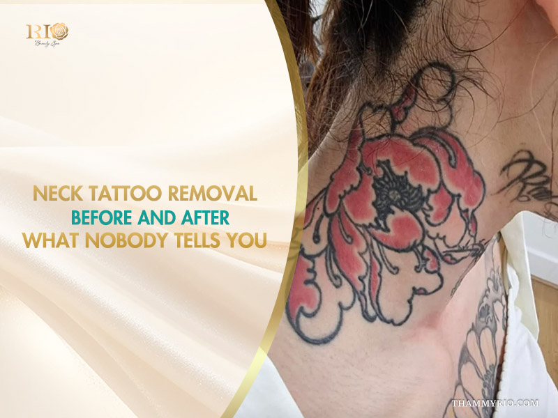 Large floral red ink neck tattoo removal before and after comparison with Rio Beauty Spa branding.