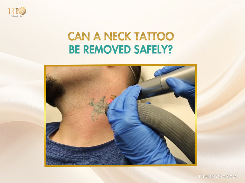 Professional laser device performing neck tattoo removal on a male patient safely.