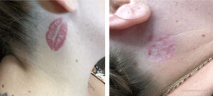 Before and after results of red ink tattoo removal on a neck area lip tattoo.
