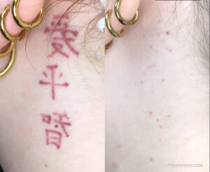 Before and after of red ink tattoo removal on a red Chinese character tattoo.