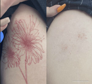 This side-by-side comparison displays effective red ink tattoo removal. The left image shows a distinct vertical red tattoo of Chinese characters. The right image, showing the area after laser treatment, reveals significant fading with only minor, healing spots remaining, demonstrating successful removal of the red pigment while the surrounding skin heals.