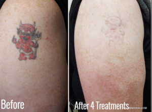Red ink tattoo removal results on a cartoon devil tattoo after 4 laser treatments.