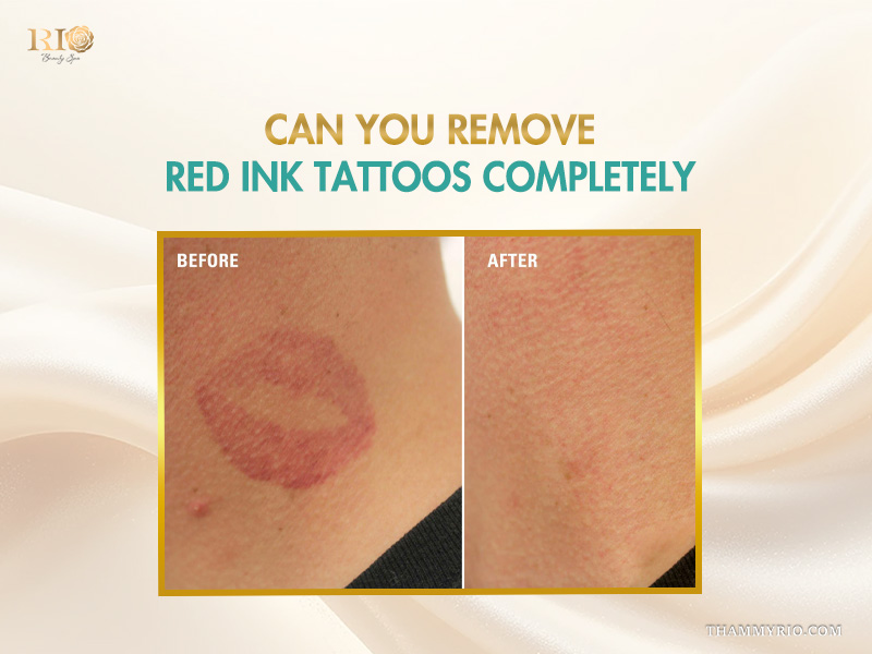 Red ink tattoo removal before and after success story.