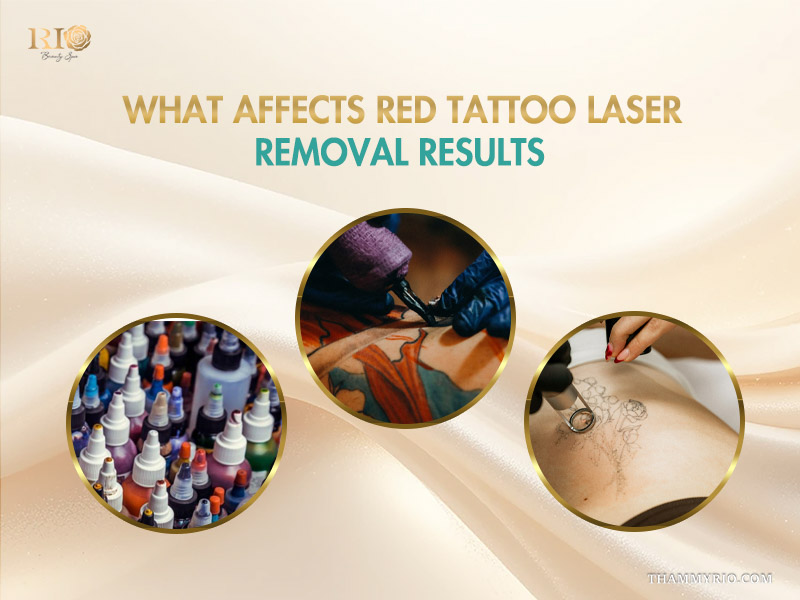 Factors affecting red ink tattoo removal results including ink quality and laser technology.