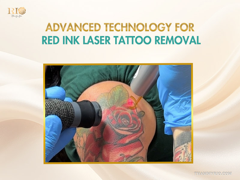 Advanced laser technology for red ink tattoo removal on a colorful rose design.