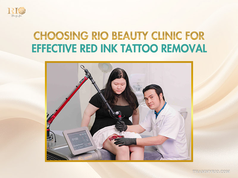 Choosing Rio Beauty Clinic for professional red ink tattoo removal with advanced laser technology.