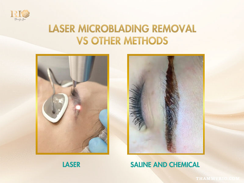 Comparison of laser and saline chemical methods for the effective removal of microblading.