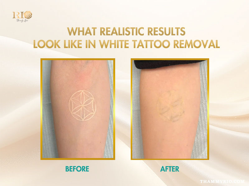 Before and after comparison of a sacred geometry flower of life pattern for removing white tattoo ink, showing significant fading.