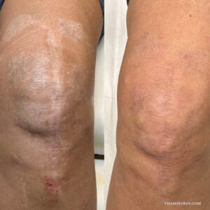 Result of scar camouflage tattoo near me in Hanoi showing before and after on leg.