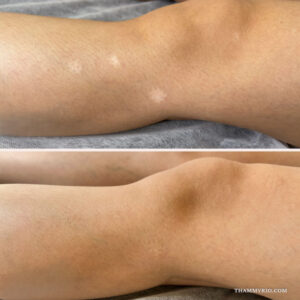 White spot treatment with scar camouflage tattoo near me in Hanoi at Thammyrio.com.