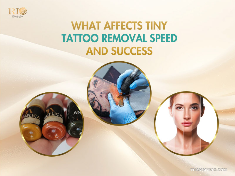 Factors affecting the success and speed of small tattoo removal, including ink bottles, the tattooing process, and skin tone.