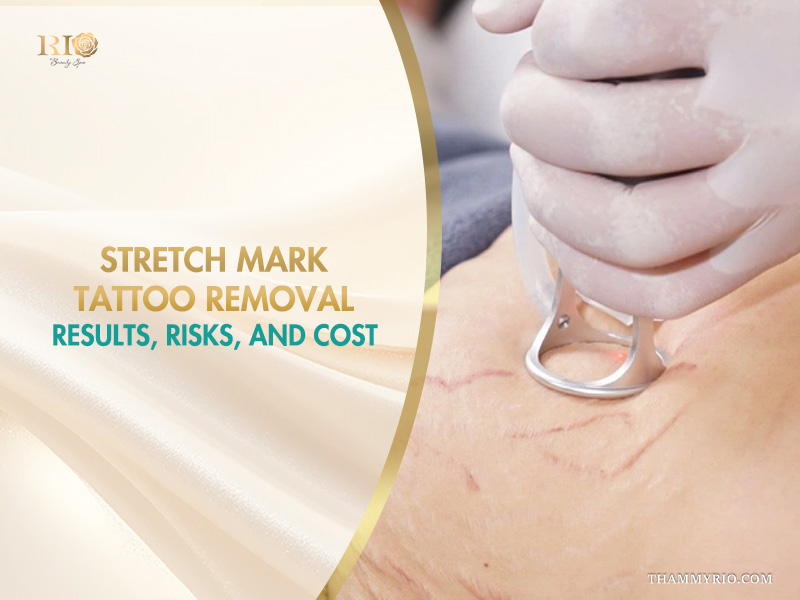 Professional stretch mark tattoo removal treatment using advanced laser technology.