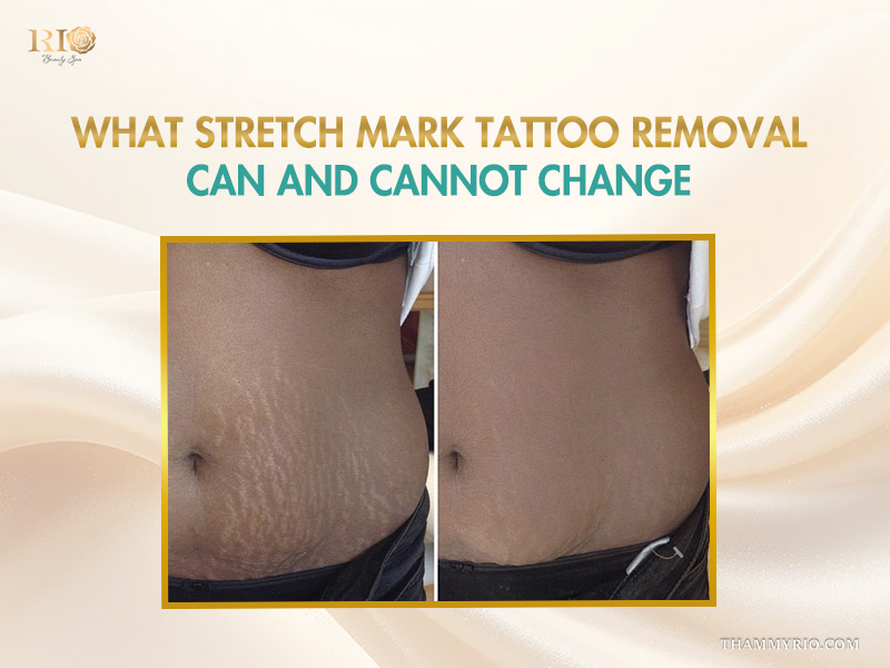 Before and after comparison of stretch mark tattoo removal showing skin texture improvement.
