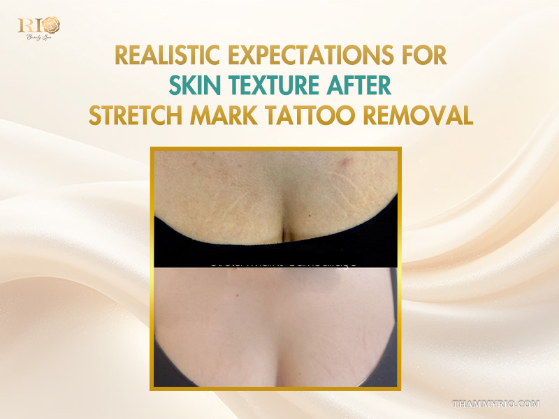 Comparison of skin texture before and after stretch mark tattoo removal treatment.