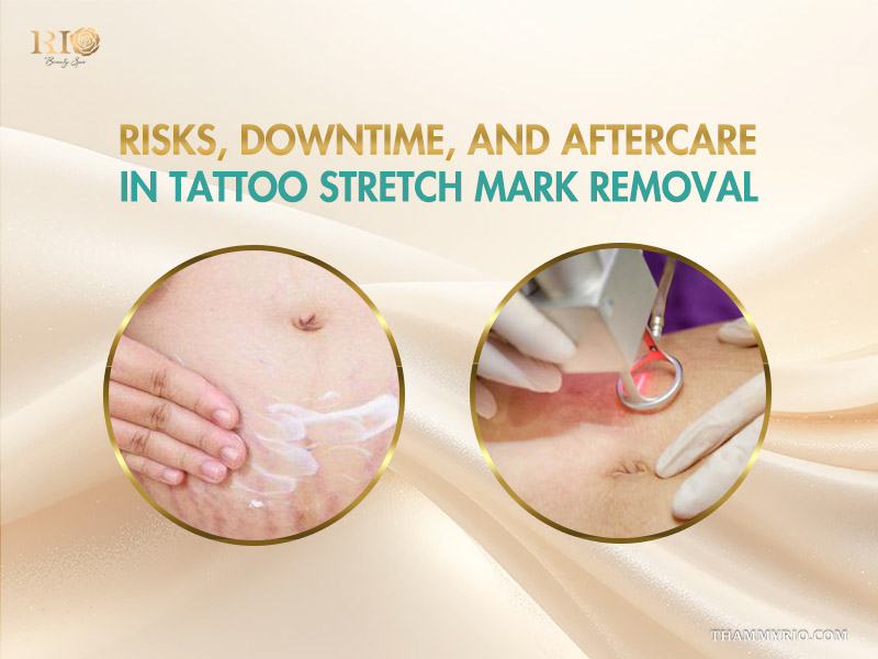 Professional aftercare and laser procedure for stretch mark tattoo removal.