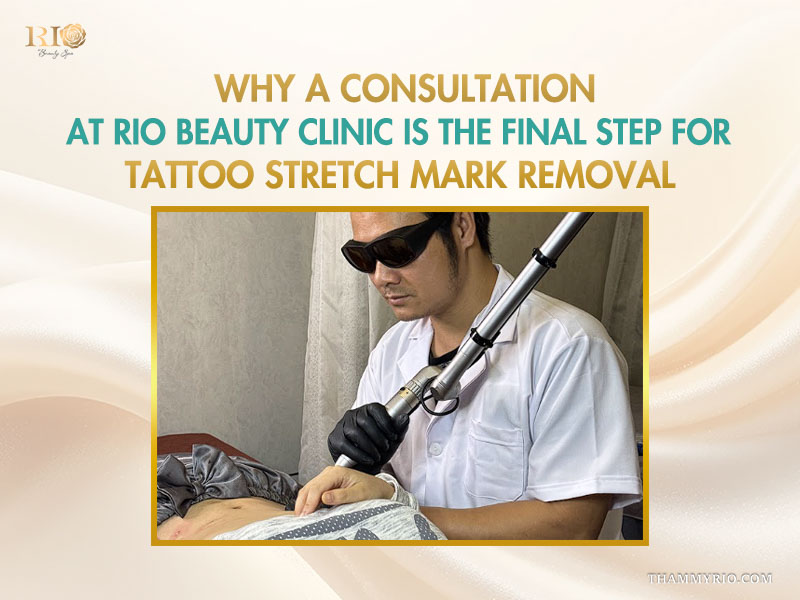 Specialist performing a laser stretch mark tattoo removal consultation at Rio beauty clinic.