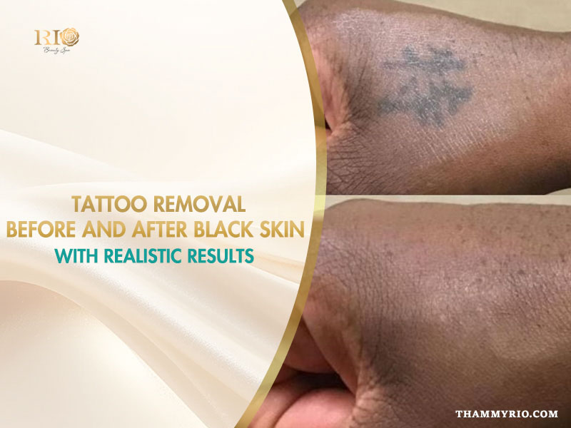 Laser tattoo removal before and after black skin results showing faded ink on dark skin tones.