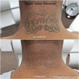 Laser tattoo removal before and after black skin on the back of the neck showing 4 treatments results.