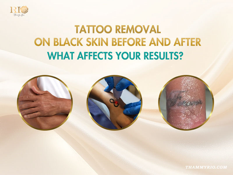 Laser tattoo removal before and after black skin process and factors affecting results.