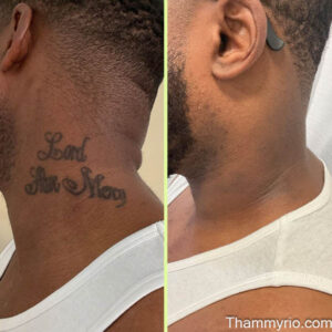 Laser tattoo removal before and after black skin on neck for a quote tattoo.