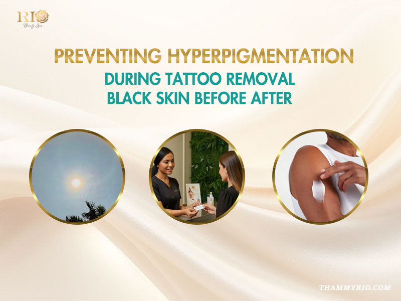 Preventing hyperpigmentation during tattoo removal before and after black skin care guide.
