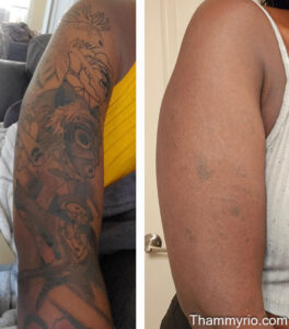 Laser tattoo removal before and after black skin on arm showing significant fading of a large illustrative tattoo.