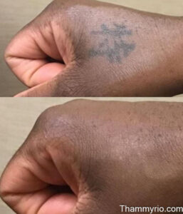 Laser tattoo removal before and after black skin on hand showing faded kanji tattoo results.
